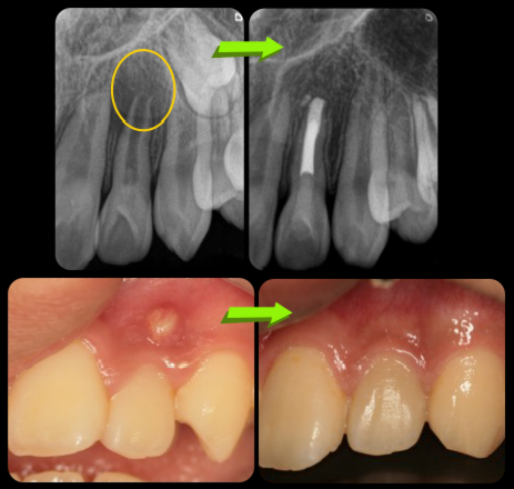 根未完成歯の感染根管治療