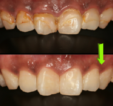 大きな虫歯による神経の治療とビルドアップ治療