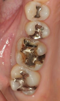 インレーの下の虫歯 (1).jpg